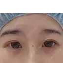 眼瞼下垂（切開） リビジョンクリニック（旧：池本形成外科・美容外科） BEFORE サムネイル用