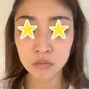 糸リフト 湘南美容クリニック 宇都宮院 BEFORE サムネイル用