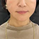 ヒアルロン酸注入（あご） / ボトックス（エラ・小顔） / ボトックス（口角） id美容クリニック 銀座院 BEFORE サムネイル用