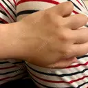 医療脱毛（指） 湘南美容クリニック 大阪梅田本院 BEFORE サムネイル用