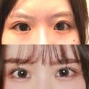 目頭切開 / 目尻切開 / 水光注射（ハリ・美肌） エートップ美容整形外科 BEFORE サムネイル用
