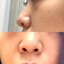 軟骨移植 フェアクリニック川口 BEFORE サムネイル用