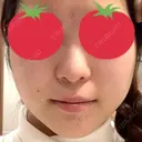 バッカルファット除去 / 脂肪吸引（顔） / ヒアルロン酸注入（涙袋） / ヒアルロン酸注入（鼻） / ヒアルロン酸注入（あご） / ボトックス（エラ・小顔） エートップ美容整形外科 BEFORE サムネイル用