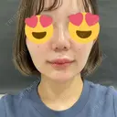 ヒアルロン酸注入（あご） id美容クリニック 銀座院 BEFORE サムネイル用