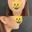 ヒアルロン酸注入（あご） / ボトックス（エラ・小顔） / ボトックス（口角） id美容クリニック 銀座院 BEFORE サムネイル用