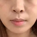 肌ヒアルロン酸注入（たるみ・シワ改善） TCB東京中央美容外科 静岡院 BEFORE サムネイル用