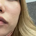 ヴェルヴェットスキン ルラ美容クリニック 大宮院 / ルラスキンクリニック 大宮院 BEFORE サムネイル用