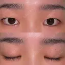 眼瞼下垂（切開） ステラ ロサ クリニック BEFORE サムネイル用