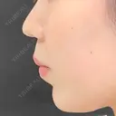 レディエッセ注入（あご） id美容クリニック 銀座院 BEFORE サムネイル用