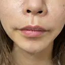 ヒアルロン酸注入（唇） / ボトックス（口角） / ボトックス（人中） ルラ美容クリニック 大宮院 / ルラスキンクリニック 大宮院 BEFORE サムネイル用