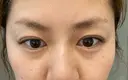 二重埋没 BIANCA表参道 BEFORE サムネイル用