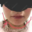 切開リフト カリスクリニック BEFORE サムネイル用