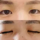 二重切開 / 上まぶたの脂肪取り 札幌ル・トロワ ビューティクリニックVogue BEFORE サムネイル用