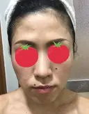 ピーリング（ニキビ・毛穴） / イオン導入 / フォトシルクプラス / ニキビ治療 ハニークリニック BEFORE サムネイル用