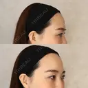 ヒアルロン酸注入（額） / ヒアルロン酸注入（こめかみ） ハナビューティークリニック BEFORE サムネイル用