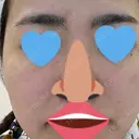 ヴェルヴェットスキン アリエル美容クリニック 大宮院 BEFORE サムネイル用