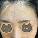 医療脱毛（顔） / 医療脱毛（背中） STARS CLINIC BEFORE サムネイル用