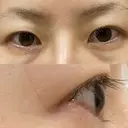 二重切開 / 目尻切開 / 上まぶたの脂肪取り / タレ目形成・グラマラスライン（切開） LIKI CLINIC KOBE BEFORE サムネイル用