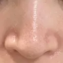 毛穴洗浄（ハイドラフェイシャルなど） STARS CLINIC BEFORE サムネイル用