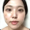 鼻尖形成（切開） / 軟骨移植 / ヒアルロン酸注入（涙袋） / ヒアルロン酸注入（唇） / ボトックス（口角） / ヒアルロン酸注入（額） 東京シンデレラ美容外科 池袋院 BEFORE サムネイル用