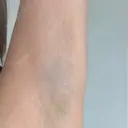 ワキ汗治療（レーザー） 聖心美容クリニック 札幌院 BEFORE サムネイル用