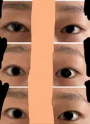 二重切開 / 眼瞼下垂（切開） / 上まぶたたるみ取り / 上まぶたの脂肪取り 城本クリニック 名古屋院 BEFORE サムネイル用