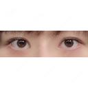 二重切開 / 眼瞼下垂（切開） / その他（目元） / 上まぶたたるみ取り / 上まぶたの脂肪取り / 目元修正 リビジョンクリニック（旧：池本形成外科・美容外科） BEFORE サムネイル用