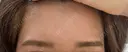 ヒアルロン酸注入（額） / ヒアルロン酸注入（こめかみ） BRIGHTS beauty clinic BEFORE サムネイル用