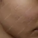 ピーリング（ニキビ・毛穴） 表参道スキンクリニック 大阪院 BEFORE サムネイル用