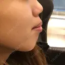 その他（輪郭） / その他（審美歯科/矯正歯科） 湘南美容クリニック 新宿本院 BEFORE サムネイル用