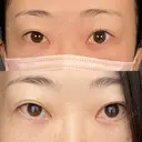 二重切開 / 上まぶたたるみ取り / PRP皮膚再生療法 BRIGHTS beauty clinic BEFORE サムネイル用