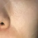 美容点滴・美容注射（疲労回復） 麗ビューティー皮フ科クリニック　大阪高槻院 BEFORE サムネイル用