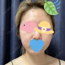 ピーリング（ニキビ・毛穴） / イオン導入 渋谷美容外科クリニック 新宿院 BEFORE サムネイル用