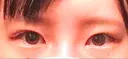 二重埋没 X CLINIC 恵比寿院 BEFORE サムネイル用