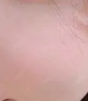 ピーリング（ニキビ・毛穴） / ニキビ治療 渋谷美容外科クリニック 新宿院 BEFORE サムネイル用