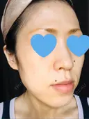 ボトックス（エラ・小顔） / ハイフ（顔） 美容皮膚科エルムクリニック 大阪院 BEFORE サムネイル用