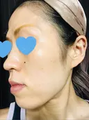 ボトックス（額） 美容皮膚科エルムクリニック 大阪院 BEFORE サムネイル用