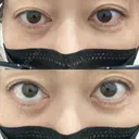 二重埋没 EMMO FACE CLINIC 大宮院 BEFORE サムネイル用