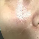 毛穴洗浄（ハイドラフェイシャルなど） 東京素肌クリニック 銀座本院 BEFORE サムネイル用