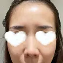 フォトRF / 光治療（フォトフェイシャルなど） 湘南美容クリニック 岡山院 BEFORE サムネイル用