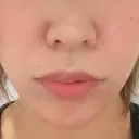 肌ヒアルロン酸注入（たるみ・シワ改善） STARS CLINIC BEFORE サムネイル用