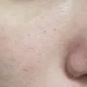 ヴェルヴェットスキン STARS CLINIC BEFORE サムネイル用