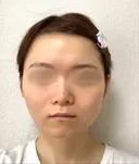 糸リフト / バッカルファット除去 / 脂肪吸引（顔） / ボトックス（あご） / ヒアルロン酸注入（あご） / ボトックス（エラ・小顔） / ヒアルロン酸注入（唇） / その他（口元） アリエル美容クリニック 大宮院 BEFORE サムネイル用