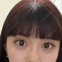二重切開 / 上まぶたの脂肪取り オーキッド美容クリニック東京御徒町 BEFORE サムネイル用