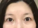 その他（目元） / クマ治療 / 上まぶたたるみ取り / 下まぶたたるみ取り eクリニック 金沢本院 BEFORE サムネイル用