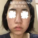 鼻尖形成（切開） / 小鼻縮小（切開） / その他（鼻） / 軟骨移植 JUN CLINIC BEFORE サムネイル用