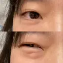 クマ治療 / 下まぶたの脂肪取り 湘南美容クリニック 長野院 BEFORE サムネイル用