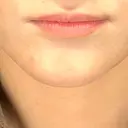 ヒアルロン酸注入（唇） / ボトックス（口角） / ボトックス（目尻） / その他（目元） TCB東京中央美容外科 高崎院 BEFORE サムネイル用