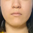 小鼻縮小（非切開） / ボトックス（エラ・小顔） 東京シンデレラ美容外科 池袋院 BEFORE サムネイル用