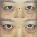 二重埋没 / クマ治療 / 上まぶたの脂肪取り リッツ美容外科 東京院 BEFORE サムネイル用